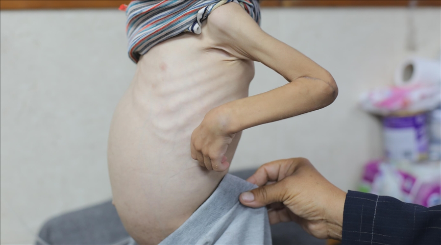 hunger as war weapon may2025