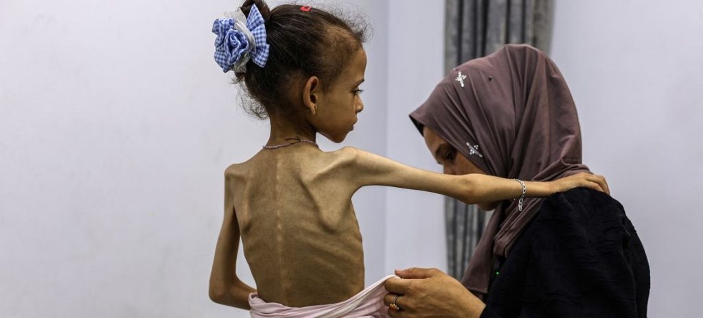 A severely malnourished girl in Gaza WHO 29jul25